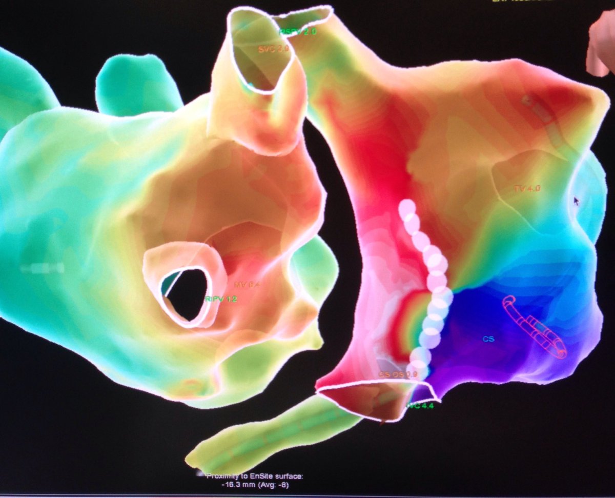 EPheartsEP's tweet photo. Atypical RA AFL; how often we think we know what it is and forget some basic entrainment can save us hours of mapping? It happens.  PPI-TCL. #epeeps #ensite #electrophysiology #navx #cardiology #prepmd https://t.co/PukBqW0r44