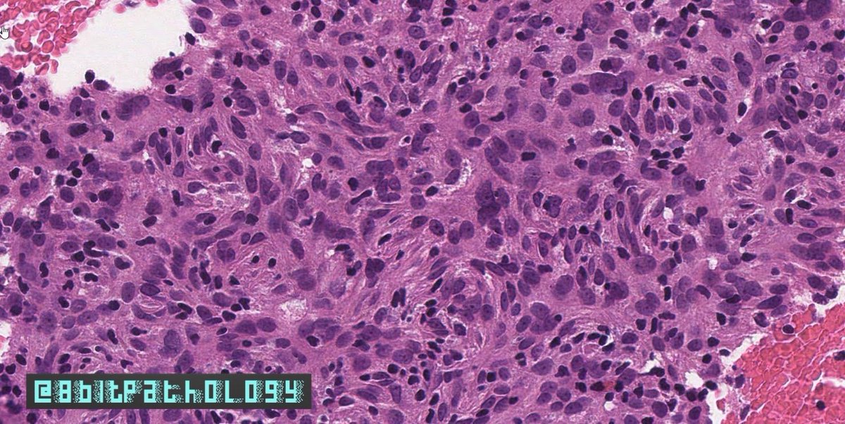 8bitPathology's tweet image. Follicular Dendritic Cell Sarcoma

📚adults (mean 50 yrs)

🔬Whorling prolif of syncytial cells w/ abundant pink cytoplasm
 📍Uniform ovoid nuclei w/ fine chromatin, distinct nucleoli, +/- focal atypia
 📍Lymphs peppered throughout

#8BitPath #HemePath #BSTPath
#ASCP40UnderForty