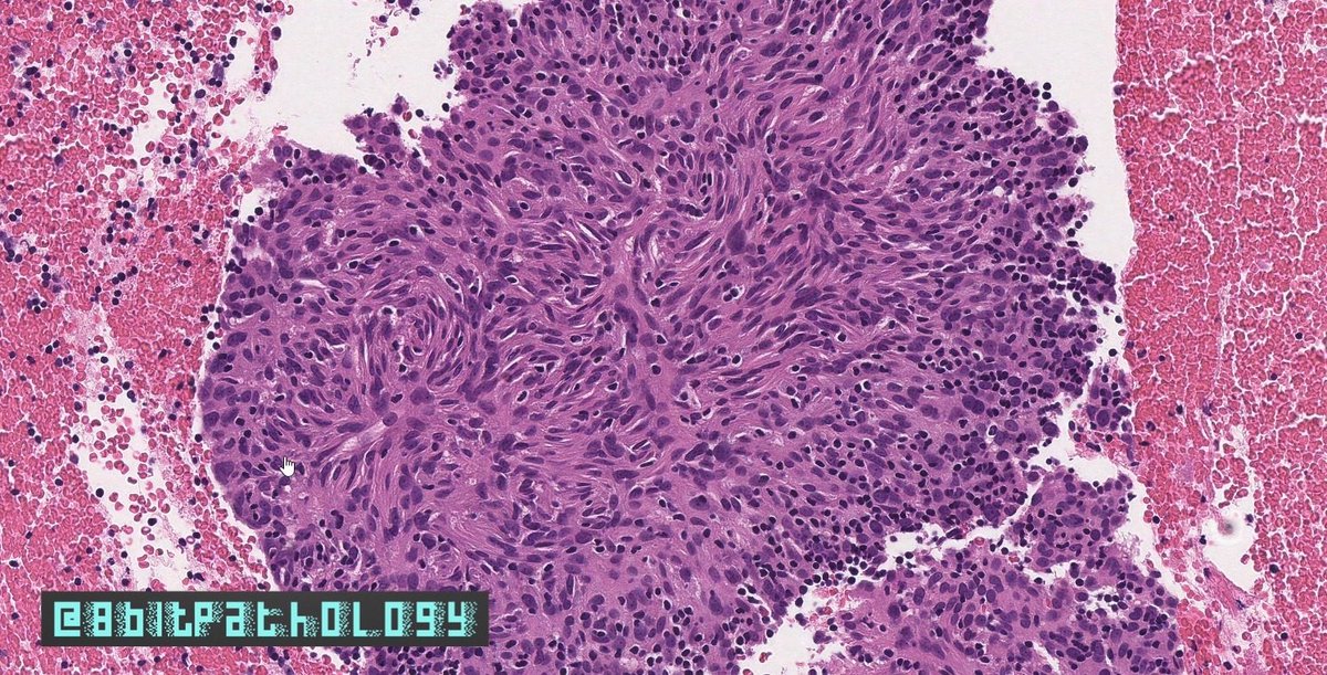 8bitPathology's tweet image. Follicular Dendritic Cell Sarcoma

📚adults (mean 50 yrs)

🔬Whorling prolif of syncytial cells w/ abundant pink cytoplasm
 📍Uniform ovoid nuclei w/ fine chromatin, distinct nucleoli, +/- focal atypia
 📍Lymphs peppered throughout

#8BitPath #HemePath #BSTPath
#ASCP40UnderForty