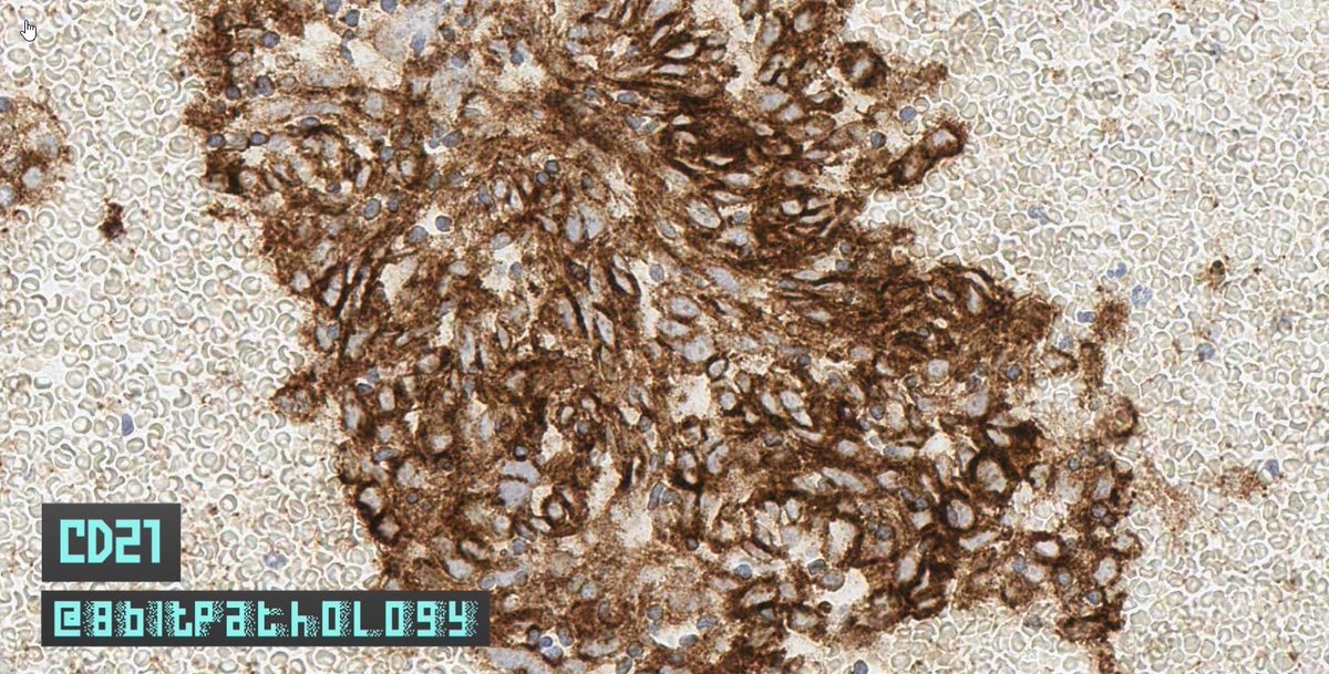 8bitPathology's tweet image. Follicular Dendritic Cell Sarcoma

📚Tx: Surg excision, but⬆️recurrence(~50%)

📍IHC:
➕CD21, CD23, CD35, Clusterin, CXCL13
➖CK, CD31, CD34, CD1a
➕/➖S100(pitfall)

For more, see:bit.ly/2YHQZSP
And:bit.ly/2YOzwnp

#8BitPath #HemePath #BSTPath
#ASCP40UnderForty