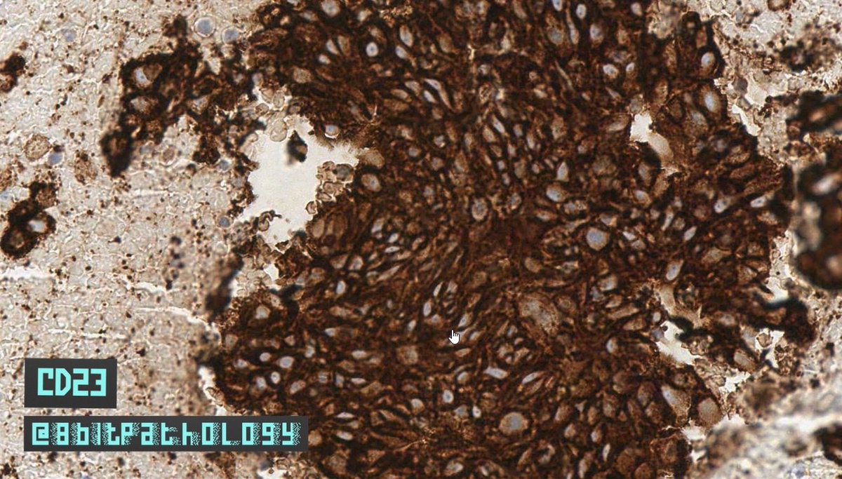 8bitPathology's tweet image. Follicular Dendritic Cell Sarcoma

📚Tx: Surg excision, but⬆️recurrence(~50%)

📍IHC:
➕CD21, CD23, CD35, Clusterin, CXCL13
➖CK, CD31, CD34, CD1a
➕/➖S100(pitfall)

For more, see:bit.ly/2YHQZSP
And:bit.ly/2YOzwnp

#8BitPath #HemePath #BSTPath
#ASCP40UnderForty