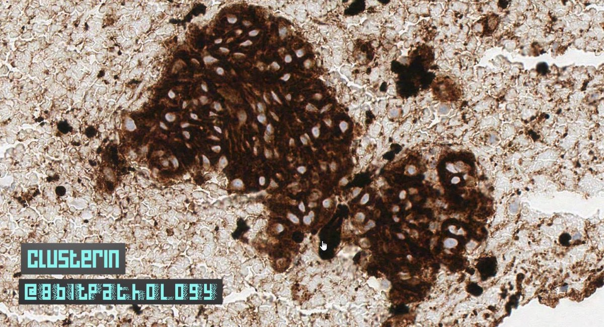 8bitPathology's tweet image. Follicular Dendritic Cell Sarcoma

📚Tx: Surg excision, but⬆️recurrence(~50%)

📍IHC:
➕CD21, CD23, CD35, Clusterin, CXCL13
➖CK, CD31, CD34, CD1a
➕/➖S100(pitfall)

For more, see:bit.ly/2YHQZSP
And:bit.ly/2YOzwnp

#8BitPath #HemePath #BSTPath
#ASCP40UnderForty