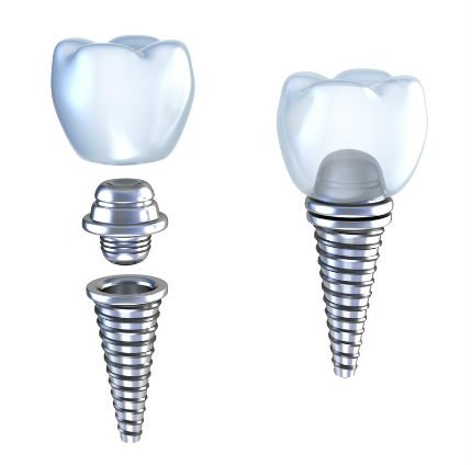 psdivya1267's tweet photo. Implant abutments are artificial devices that are connected to the #dentalimplants. The abutments are used to attach a crown, bridge, or removable #denture to the implant fixtures.
It includes two classes prefabricated &amp; custom made
Submit your abstracts https://t.co/ryOS2ONvdT https://t.co/33et9Wy6qE