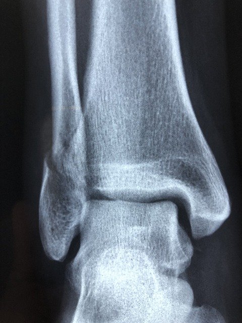 CatalanTrauma's tweet photo. Presenta hasta 3⃣ grados en función de la gravedad de la lesión, y generalmente aparece una hinchazón importante de la articulación y hematoma.

👉 Es aquí donde entra en acción el uso del vendaje compresivo. https://t.co/ijOn224ht3