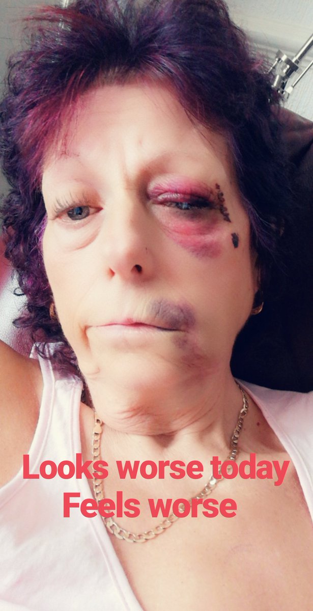 disco_diva59's tweet photo. A little update after my fall on the way to #imagetherapy Tue I've got about 4hrs memory loss, still went to group weighed in, spoke but got upset for woty, sat for 2 groups sadly can't remember anything but still I'm target 33mth 11st7lb loss @slimmingworld #lifechanging https://t.co/i11RQHnSIo
