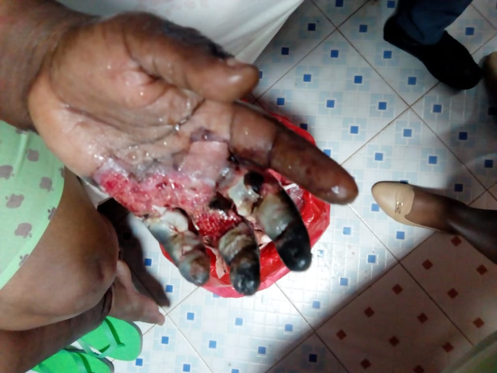 dhahabumedia's tweet photo. GRAPHIC IMAGES

Susan Muthoni Nyaga attended County Medical Centre in Embu and was a victim of wrongly administered injection on her arm. She has since developed serious complications and her arm is even Rotting and peeling off. She is crying for Help. #CloseCountyMedicalHospital https://t.co/pQh33Gn1C5