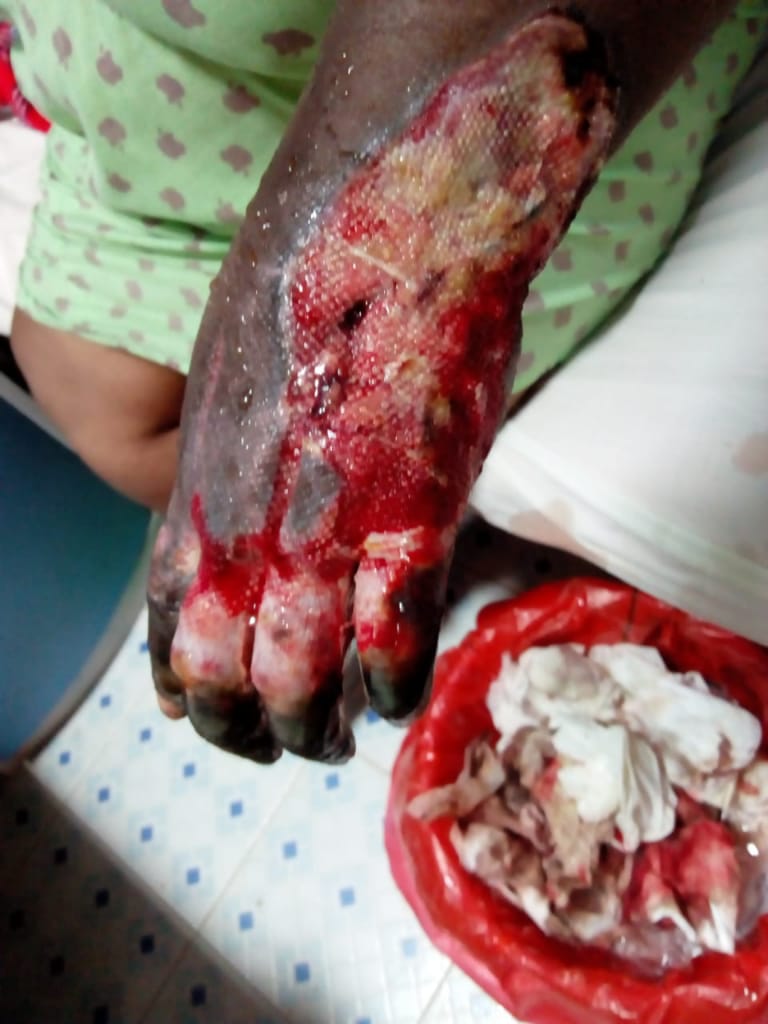 dhahabumedia's tweet photo. GRAPHIC IMAGES

Susan Muthoni Nyaga attended County Medical Centre in Embu and was a victim of wrongly administered injection on her arm. She has since developed serious complications and her arm is even Rotting and peeling off. She is crying for Help. #CloseCountyMedicalHospital https://t.co/pQh33Gn1C5