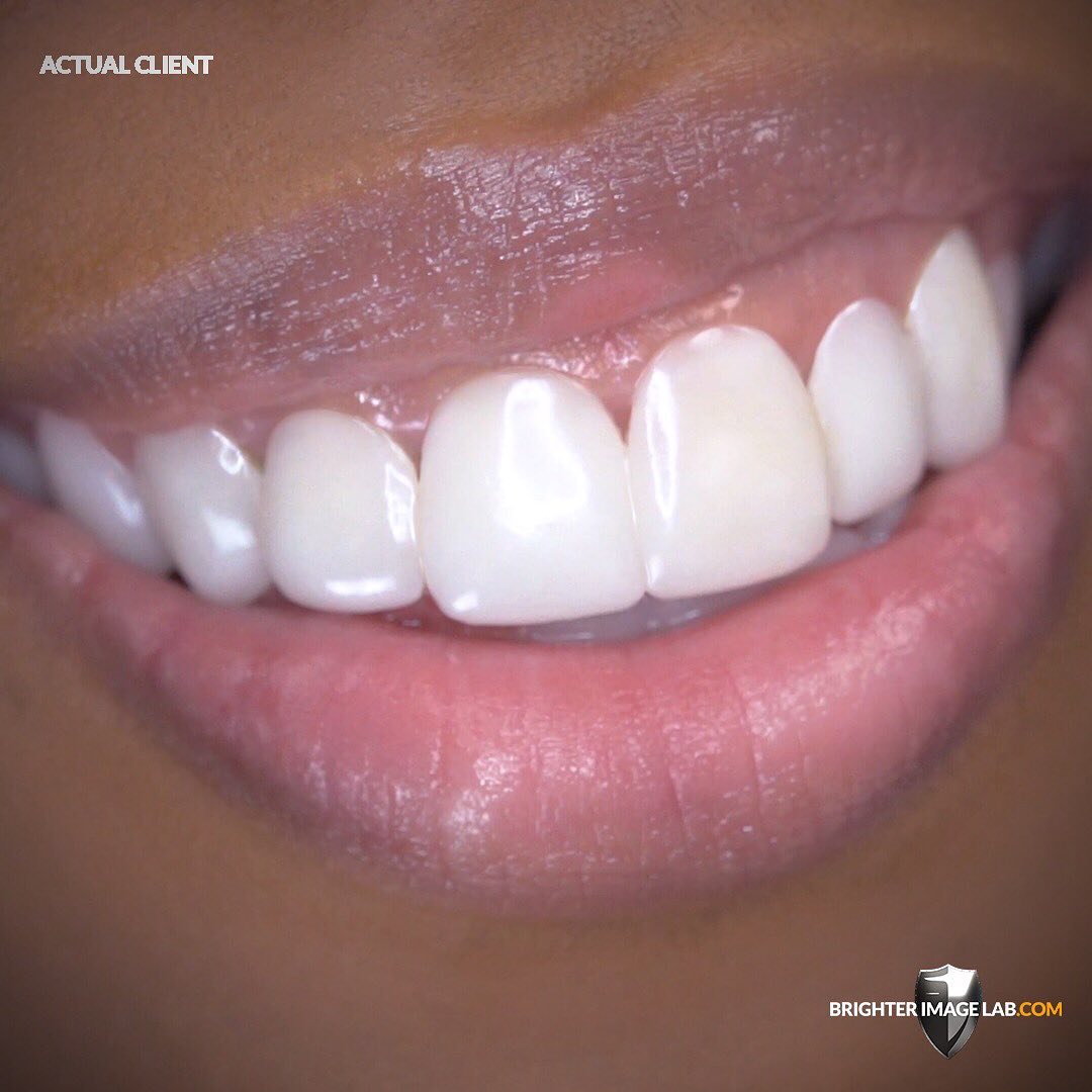 brighterimage01's tweet photo. I'm extremely grateful to be able to work with this International Model, Beauty Pageant Client - She couldn't be more happy with her results!
Learn more at https://t.co/C3qBRbJXui
#brighterimagelab #dentalveneers #pressonveneers #bilveneers #incredibil #smilemakeover #smiledesign https://t.co/tkBRLCRVNM