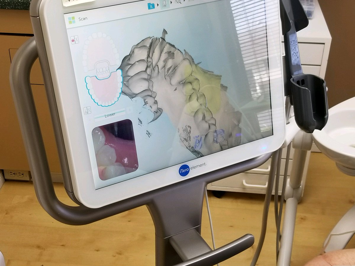 Our iTero scanner eliminates the mess and discomfort of traditional impressions for many procedures.