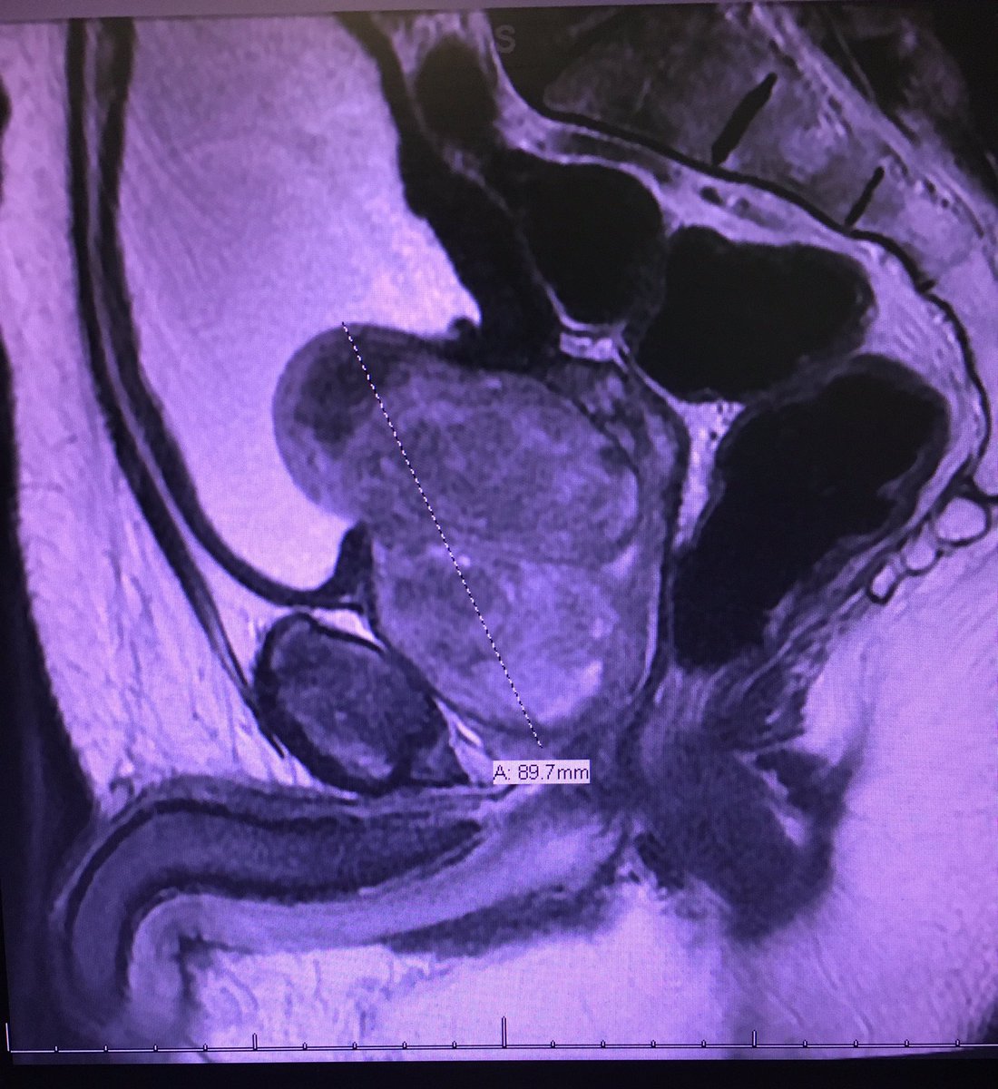 NickelCityUro's tweet photo. 🚨Uro Crowdsource 🚨 
68 year old triathete comes in asking for urolift. Obstructive voiding, 2 culture positive UTIs last year and PVR 210. Prostate MRI (PI-RADS 2) and a mountainous 210g gland. Very med averse. What to do? Marathon turp / TUEB / open simple / Embolize? https://t.co/jkVKW2DGVD