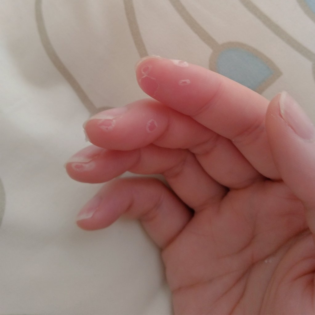 はまい 手足口病の跡が皮むけてきて指先の感覚が気持ち悪い 罒