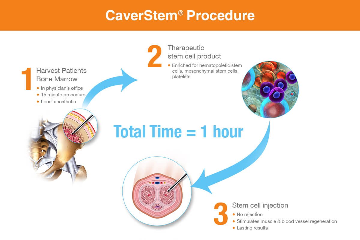 7 Benefits of CaverStem®

1. 100% Natural
2. Uses Your Own Stem Cells
3. Permanent Solution
4. Safe Procedure by a Licensed Physician
5. 1 Hour Procedure
6. FDA Approved Equipment
7. No Side Effects

Schedule your consultation bit.ly/RMHAppointment
 
#LasCruces #ElPaso #ABQ
