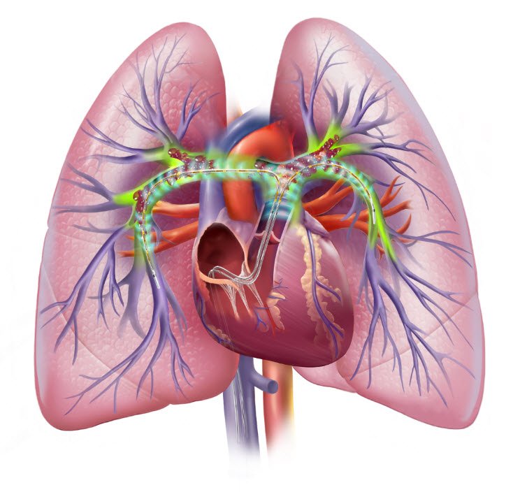 BTGVascular's tweet photo. Systemic lytic or low-dose tPA? EKOS Therapy delivers low-dose thrombolytic to the core of the clot in this video https://t.co/a0AgLUoNuW. Learn more about PE treatment with EKOS at  https://t.co/HrDLdpOkSc. #EKOSTherapy #PETreatment #OPTALYSEPE https://t.co/nAS0BRpFsm