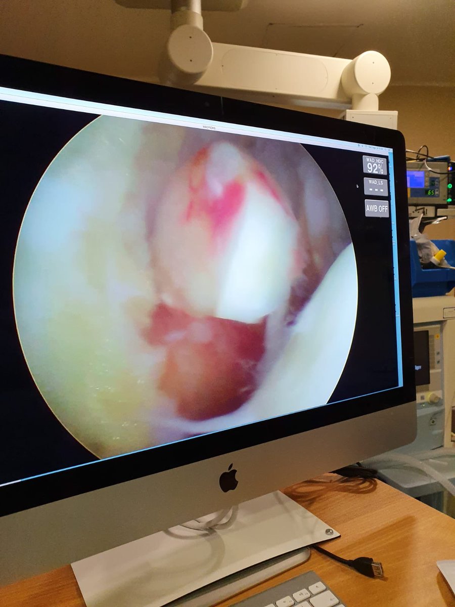 DraIsaGuillen's tweet photo. El tto del paciente de esguince de tobillo: artroscopia:extirpar el fragmento anterior, revisar el LPAA que estaba perfecto, la lesión condral era grande pero en gotiera medial.zona de no carga. Tomamos biopsia de cartílago #preicc para congelar. Ahora tto reha. Deporte ocasional https://t.co/a1IOLMtGUz