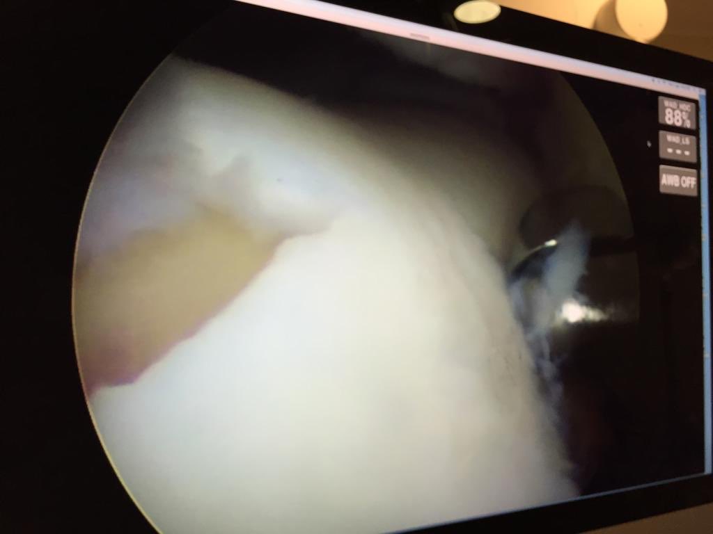 DraIsaGuillen's tweet photo. El tto del paciente de esguince de tobillo: artroscopia:extirpar el fragmento anterior, revisar el LPAA que estaba perfecto, la lesión condral era grande pero en gotiera medial.zona de no carga. Tomamos biopsia de cartílago #preicc para congelar. Ahora tto reha. Deporte ocasional https://t.co/a1IOLMtGUz
