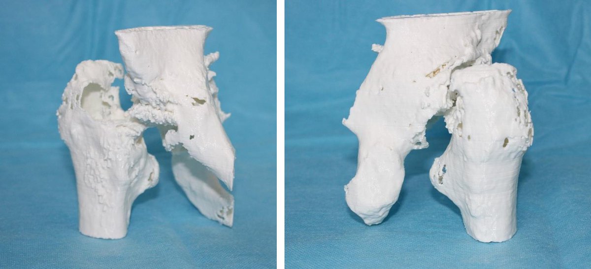 OrthoFeed's tweet image. 3D Printed Medical Models for Hip Surgeries Prove to Be Helpful but Expensive orthofeed.com/2019/08/08/3d-… #3dmodels #3dprinting #ComplexProcedures #HipReplacement #orthopedics #orthopaedics #SurgicalPlanning #research #THR