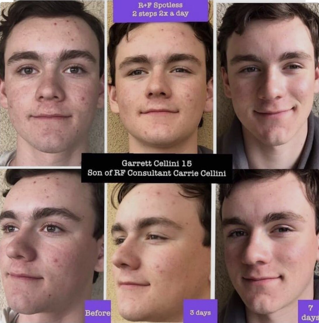 SelmaGabbert's tweet photo. It has been an amazing #summer here in #alaska  School starts back up soon, is your teen ready?  Spotless gets rid of #teen and #youngadult #acne   Get your teen ready by starting them in spotless.   #backtoschool #wellness. https://t.co/Nzpb0stYpy