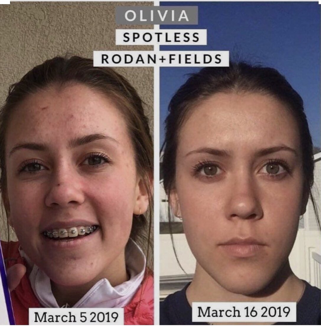 SelmaGabbert's tweet photo. It has been an amazing #summer here in #alaska  School starts back up soon, is your teen ready?  Spotless gets rid of #teen and #youngadult #acne   Get your teen ready by starting them in spotless.   #backtoschool #wellness. https://t.co/Nzpb0stYpy