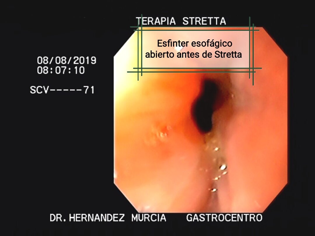 chriscirugia's tweet photo. Caso de este día. Tratamiento del reflujo SIN cirugía. Terapia Stretta. Procedimiento ambulatorio, realizado por endoscopia, sin incapacidad. @StrettaTherapy @CJMStretta @RayBengermino1 #strettatherapy #ElSalvador https://t.co/fsTLsfaZ3P