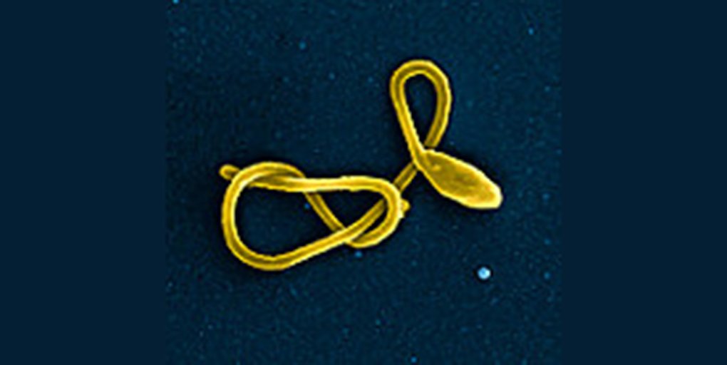 Medscape's tweet photo. New evidence of significant vitreoretinal pathology in #Ebola survivors, even years later, has surgical teams taking note. https://t.co/2Nqcj7wLsr #ASRS2019 https://t.co/J7E0k6Pqxe