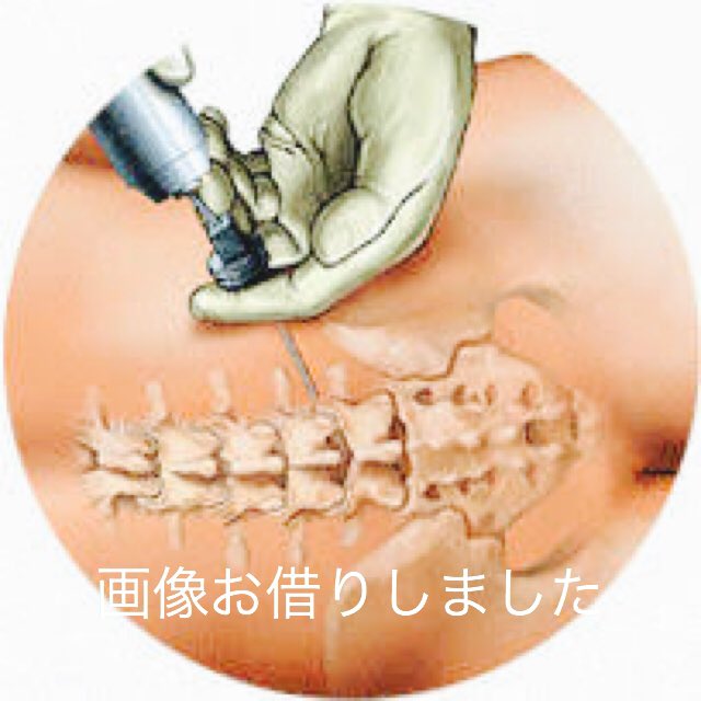 仙骨 ブロック 注射