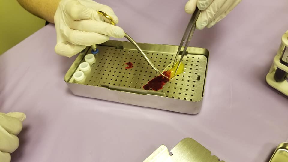 MiriamTingDMD's tweet photo. The Implant focus group of the Think Dental Learning Institute gathered this summer, July 29th or 30th to learn about evidence-based clinical applications of platelet concentrates, and to experience first hand, how to make L-PRF plugs and membranes. Fun and exciting! https://t.co/SDMNUAigoI