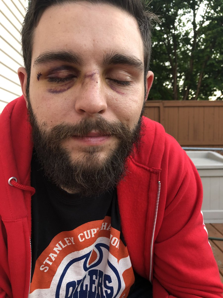 jR0WWW's tweet image. To Igor from the @StrathcoCounty Hospital in Sherwood Park:
Thanks for fixing Derek’s nose! He is able to breathe better and it’s a little straighter than before. Thanks!!! @AHS_media