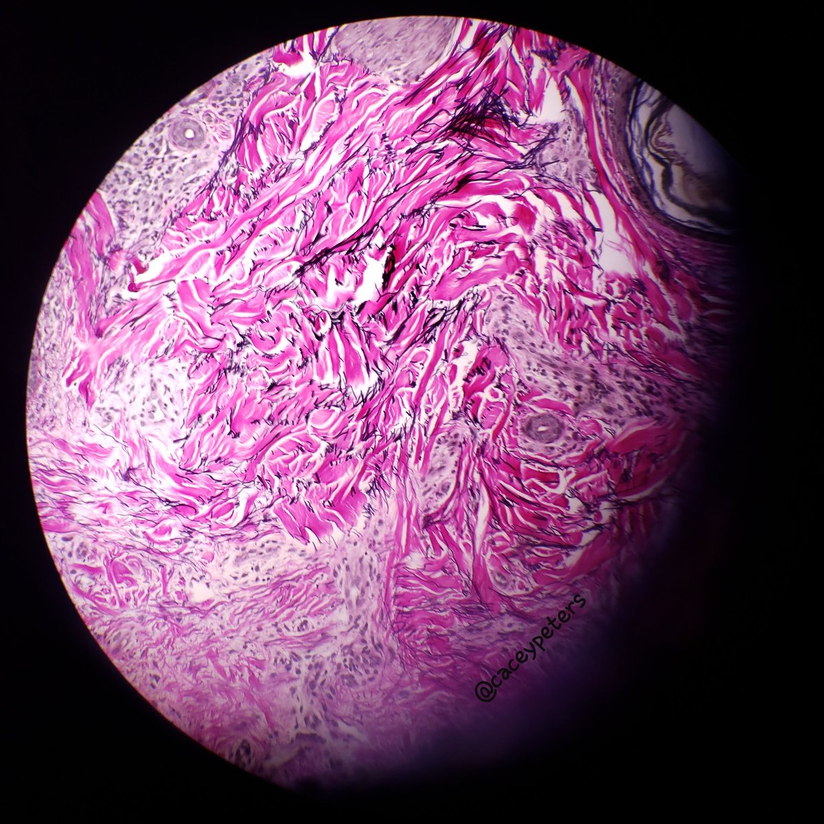 caceypeters's tweet photo. Planet Elastin
#pathplanet #microcosm #pathology #dermpath #pathart #dermatology #astropath #FridayMorning #FridayFeeling https://t.co/kxsTWDAJPu