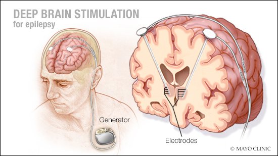 MayoClinic's tweet photo. #DeepBrainStimulation can be used to treat #ParkinsonsDisease by implanting electrodes in the brain. Meet others and share experiences on #MayoClinicConnect. https://t.co/AITnx9g2ef https://t.co/Cxm30LmaCa
