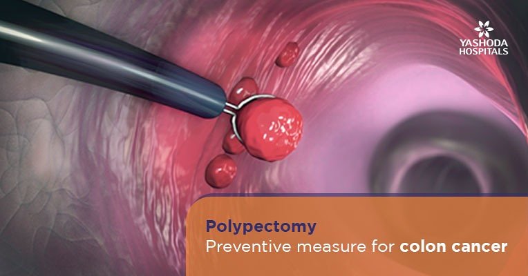 YashodaHospital's tweet image. Colon polyps can be painful or silent without any symptoms. 

You can prevent them from turning cancerous with timely screening and removal by #polypectomy.

Read more: bit.ly/2GYbxMw

#colonoscopy
#colonpolyps
#YashodaHospitals