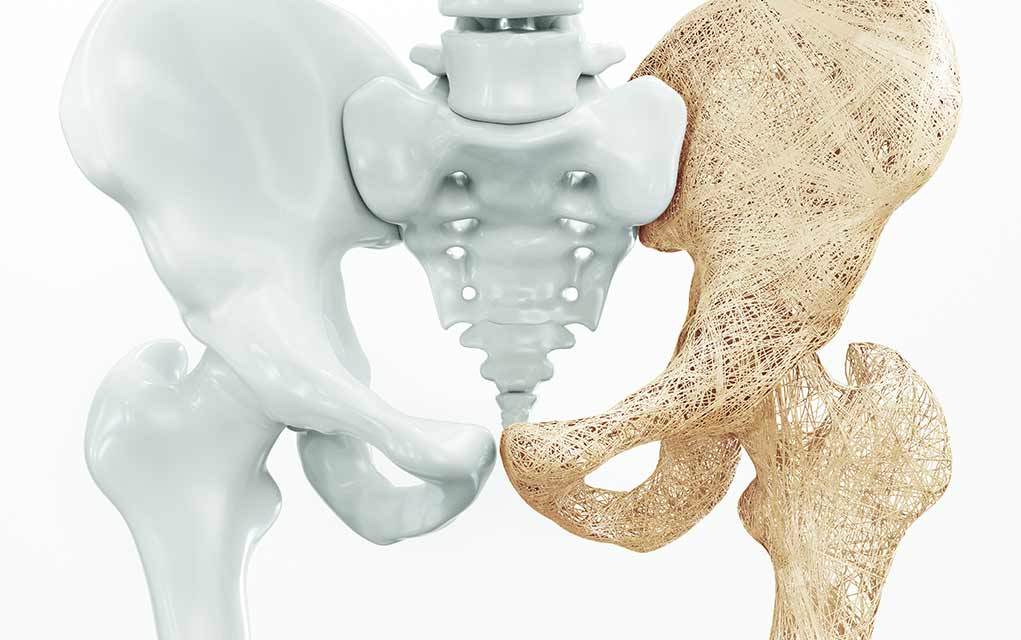 wellnessgroup's tweet image. Finally, Some Hope for Those With Osteoporosis wellness.com/blog/13294782/… on the #WellnessBlog