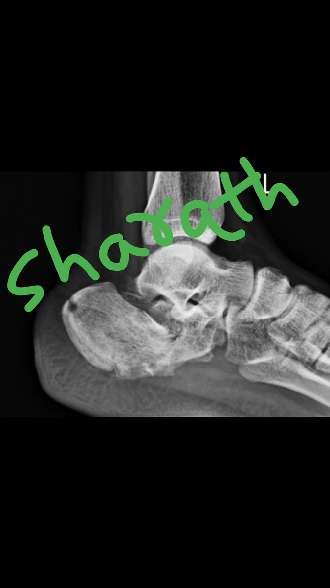 RamanathSharath's tweet photo. Calcaneus comminuted  Fracture internal fixation with LCP.
#Calcaneusfracture
#ORIF
#Fracturesurgery
#fractureandorthoclinic
#Orthopedics 
#footandankle
#orthosurgerybangalore https://t.co/BOZmkglWlK