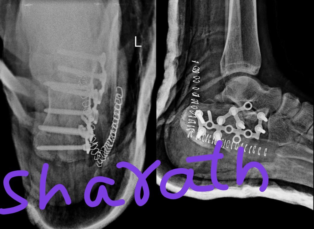 RamanathSharath's tweet photo. Calcaneus comminuted  Fracture internal fixation with LCP.
#Calcaneusfracture
#ORIF
#Fracturesurgery
#fractureandorthoclinic
#Orthopedics 
#footandankle
#orthosurgerybangalore https://t.co/BOZmkglWlK