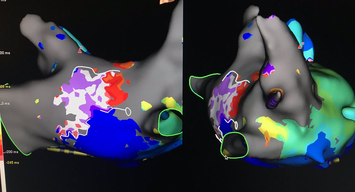 JNR8504's tweet image. HD grid making life easy!!! #HDgrid #Abbott #atypicalflutter