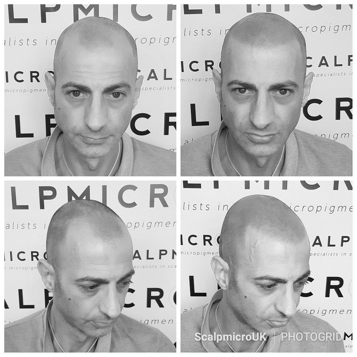 Scalp Micro UK tweet media