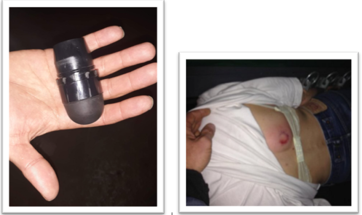 Feministfest's tweet photo. Dessa gummiprojektiler tillåts i Macrons Frankrike (ett arv från Sarkozy) att skjutas rakt mot obeväpnade medborgare.
Vems säkerhet är det, Peter Hultqvist? #militarism
De skjuts tom rätt in i människors ögon med blindhet som följd och i ryggen (!) på en kvinna. #flashballs https://t.co/4AG7eEQGbm