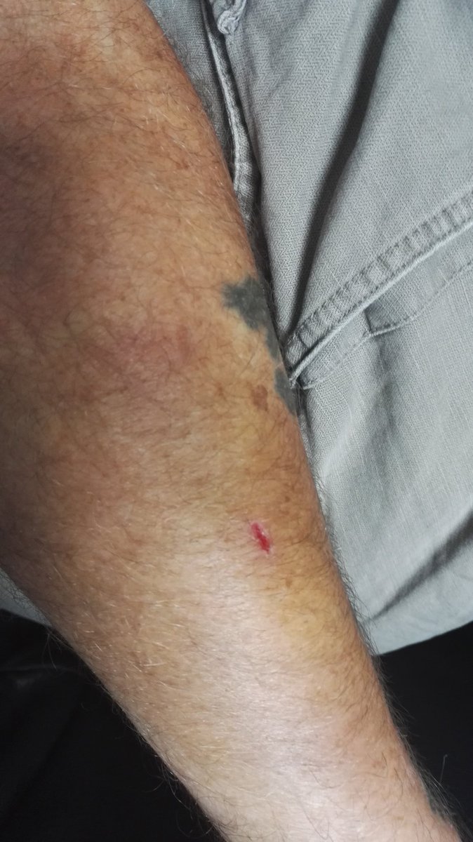 Aggers_Mrs's tweet photo. @Agger Snorted?? You mean snotted! This is the mess you made of your arm. #dozybastard #doddery https://t.co/Gltb64WK4F