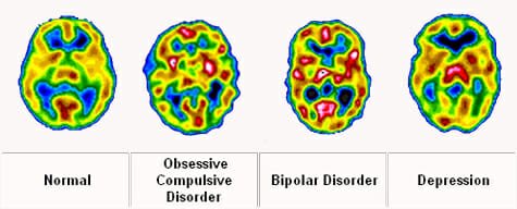 Bridge_FIT's tweet photo. Did you know that most who suffer from mental illness have brains that work differently? We tell the suffering to “think” their way out of their pain but we dont have the same expectations for people w/ diabetes or a broken leg. Just b/c you cant see it doesn’t mean it isn’t real https://t.co/KkbkAisLPd
