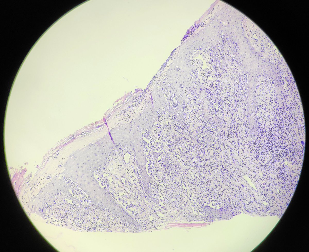 padmapathology1's tweet photo. Female in 70s. Ulcer in foot, second web space, suspicious for SCC. No immunos available. How should we send out the report? Give DDs and advise immunos or one diagnosis? What would that be? Your thoughts ๐ #pathology #dermpath #oncopath #incompleteworkup #practicalproblems https://t.co/fHsFOLo46e
