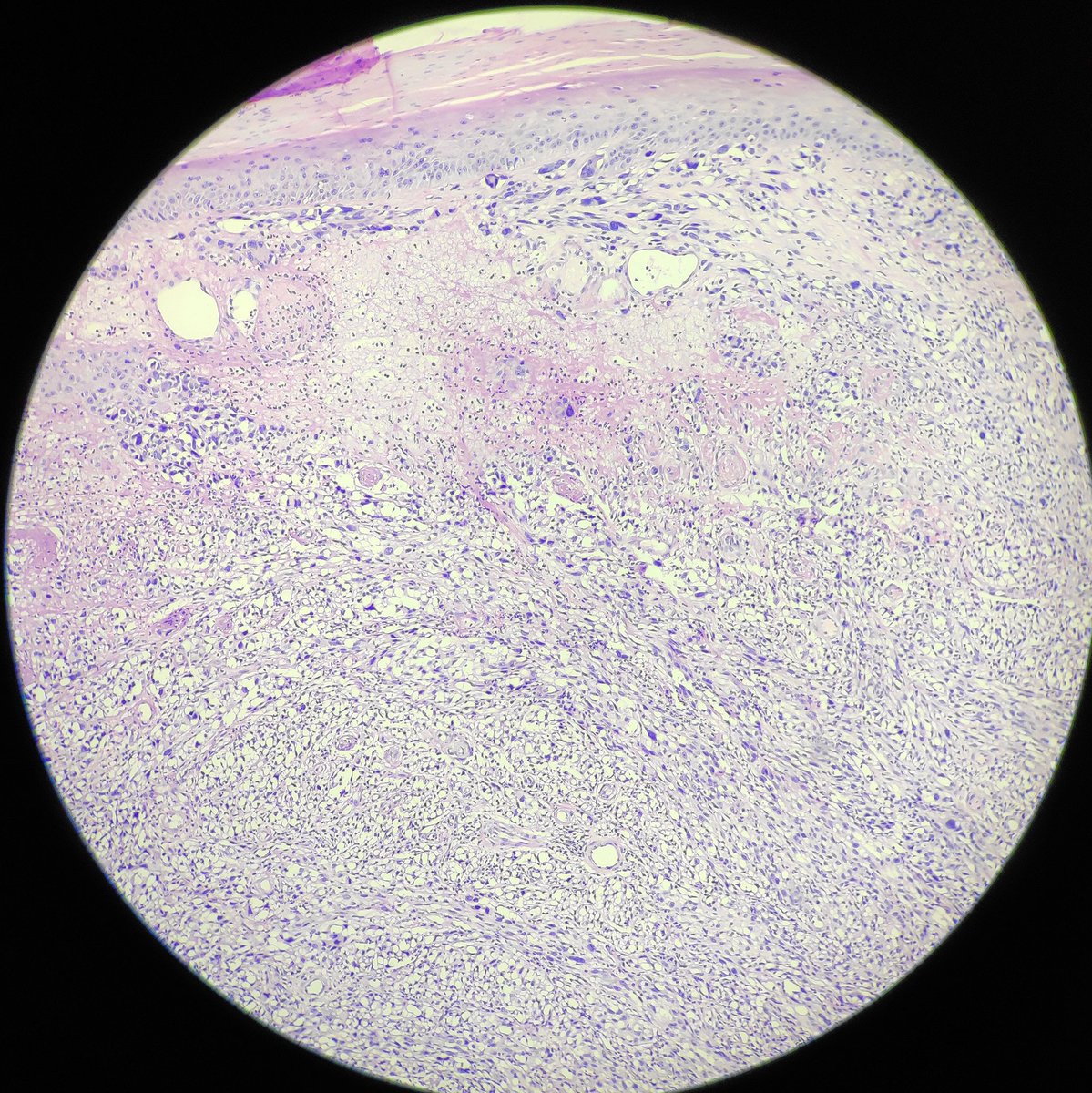 padmapathology1's tweet photo. Female in 70s. Ulcer in foot, second web space, suspicious for SCC. No immunos available. How should we send out the report? Give DDs and advise immunos or one diagnosis? What would that be? Your thoughts ๐ #pathology #dermpath #oncopath #incompleteworkup #practicalproblems https://t.co/fHsFOLo46e