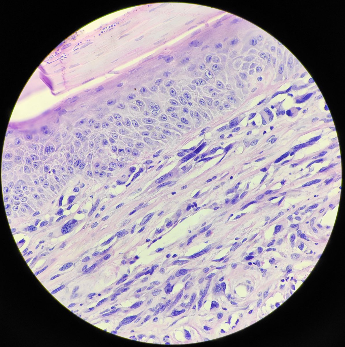 padmapathology1's tweet photo. Female in 70s. Ulcer in foot, second web space, suspicious for SCC. No immunos available. How should we send out the report? Give DDs and advise immunos or one diagnosis? What would that be? Your thoughts ๐ #pathology #dermpath #oncopath #incompleteworkup #practicalproblems https://t.co/fHsFOLo46e