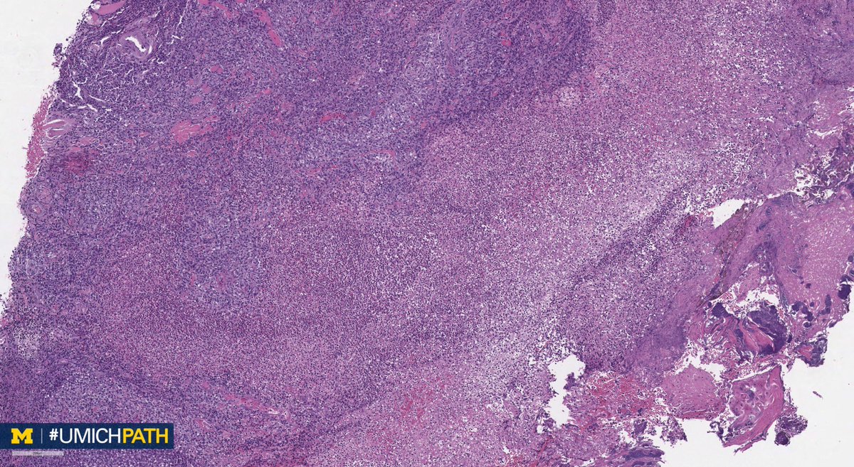UMichPath's tweet image. 🔬 Oral #Pathology, Day 5
 
➡️ What’s your #DailyDx of this tongue lesion?
 
➡️ We’ll tweet the answer and some quick facts tomorrow! #UMichPath #ENTPath