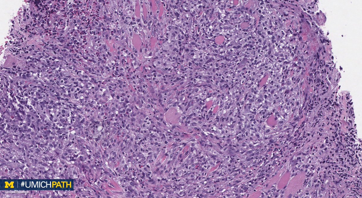 UMichPath's tweet image. 🔬 Oral #Pathology, Day 5
 
➡️ What’s your #DailyDx of this tongue lesion?
 
➡️ We’ll tweet the answer and some quick facts tomorrow! #UMichPath #ENTPath