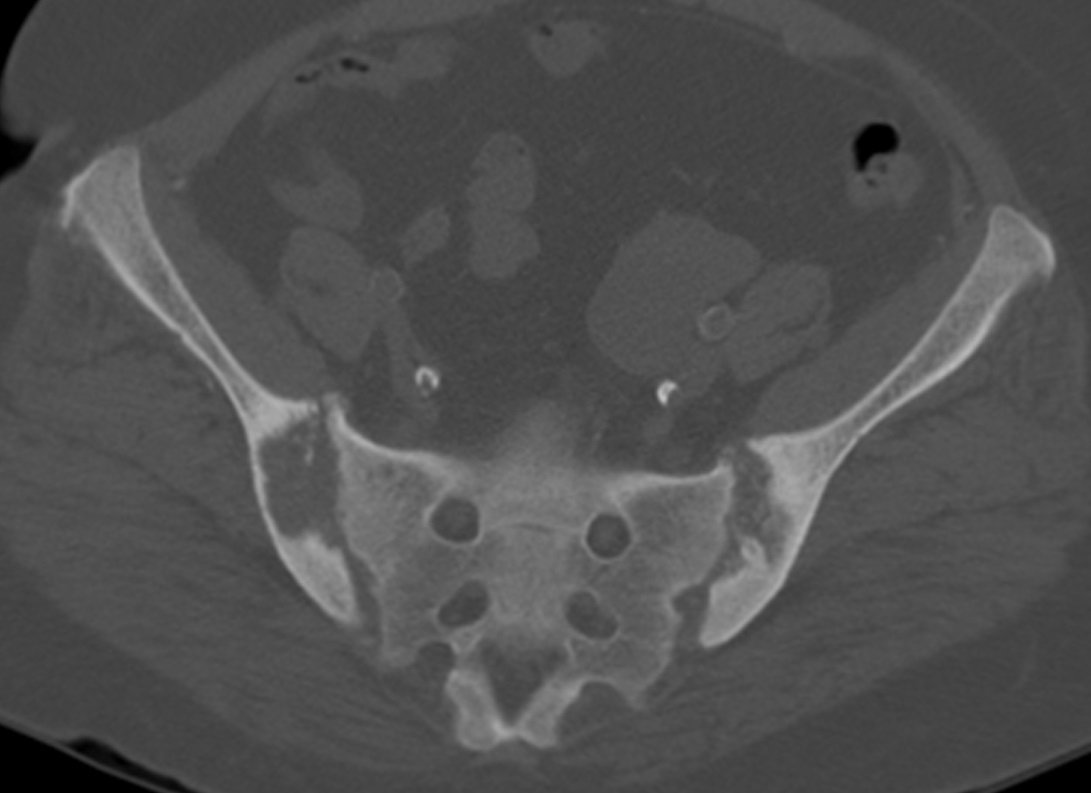 MSKfellowship's tweet photo. CXR can tell the whole story. PermCath = chronic renal failure. Subchondral resorption of the AC joints = 2ndary hyperparathyroidism related to renal osteodystrophy. 

CT confirms with sacroiliac resorption and "Rugger Jersey" spine. #mskrad #radres

https://t.co/nrgIrJkZkd https://t.co/3uUy7Nwnf3