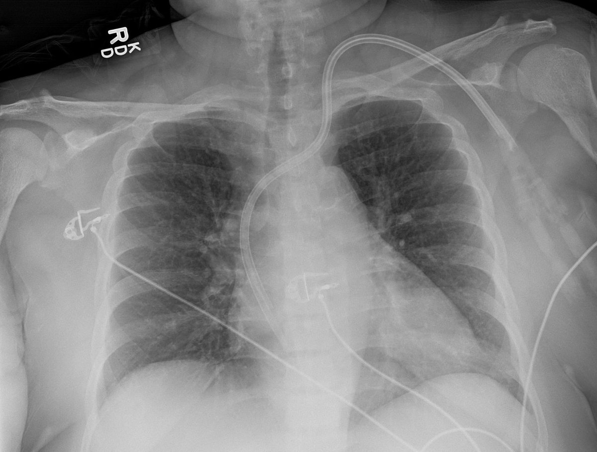 MSKfellowship's tweet photo. CXR can tell the whole story. PermCath = chronic renal failure. Subchondral resorption of the AC joints = 2ndary hyperparathyroidism related to renal osteodystrophy. 

CT confirms with sacroiliac resorption and "Rugger Jersey" spine. #mskrad #radres

https://t.co/nrgIrJkZkd https://t.co/3uUy7Nwnf3