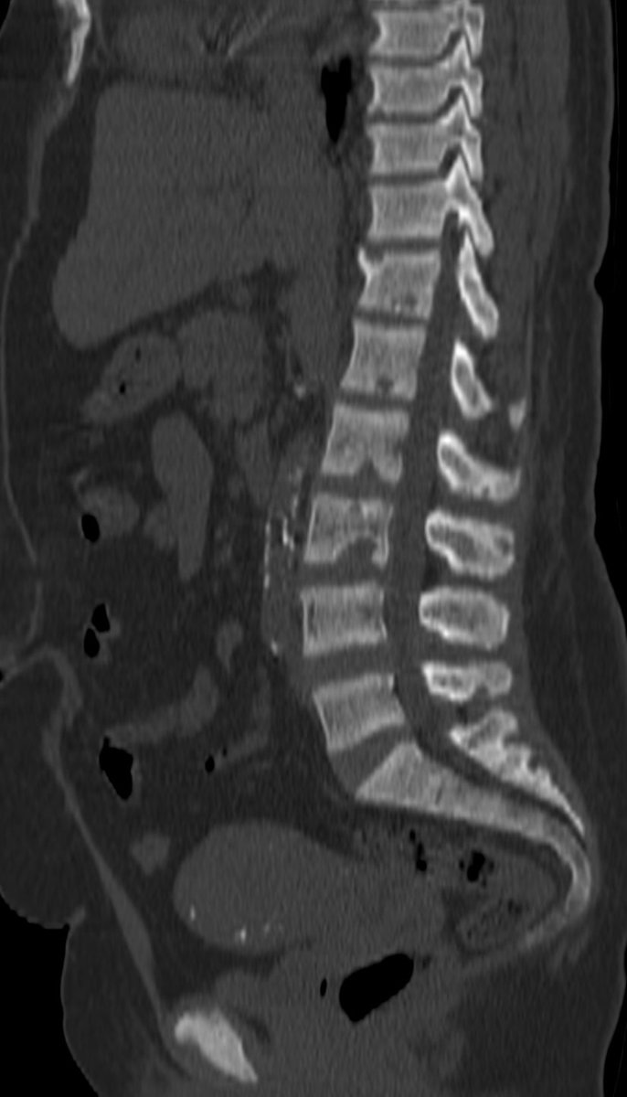 MSKfellowship's tweet photo. CXR can tell the whole story. PermCath = chronic renal failure. Subchondral resorption of the AC joints = 2ndary hyperparathyroidism related to renal osteodystrophy. 

CT confirms with sacroiliac resorption and "Rugger Jersey" spine. #mskrad #radres

https://t.co/nrgIrJkZkd https://t.co/3uUy7Nwnf3