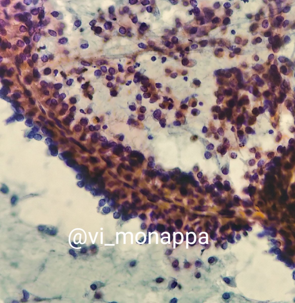 vi_monappa's tweet photo. 2 lesions from 2 related organs. Can u guess the site and lesion. 😀#pathquiz #pathology #cytopath @kriyer68 @smlungpathguy https://t.co/D9Sb1hlVTm