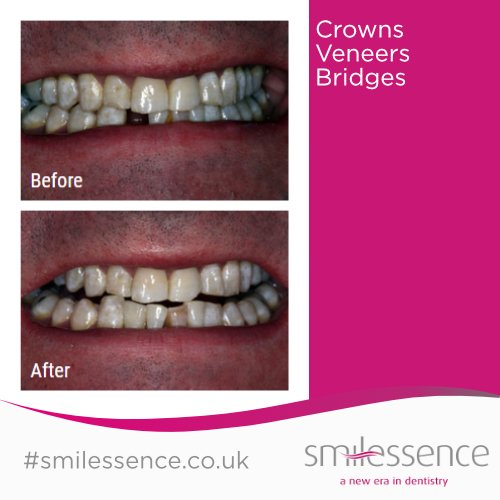 SmilessenceUK's tweet photo. CROWN, VENEERS &amp; BRIDGES  C2-Beautiful teeth😁

Thank you to our clients for allowing us to show off what is a very private thing for most people. For more smile makeovers head to 
https://t.co/KTEoxDKlRK
#dental #dentist #dentistry #teeth #smile #tooth #crowns #veneers #bridges https://t.co/lCYwCo0RaQ
