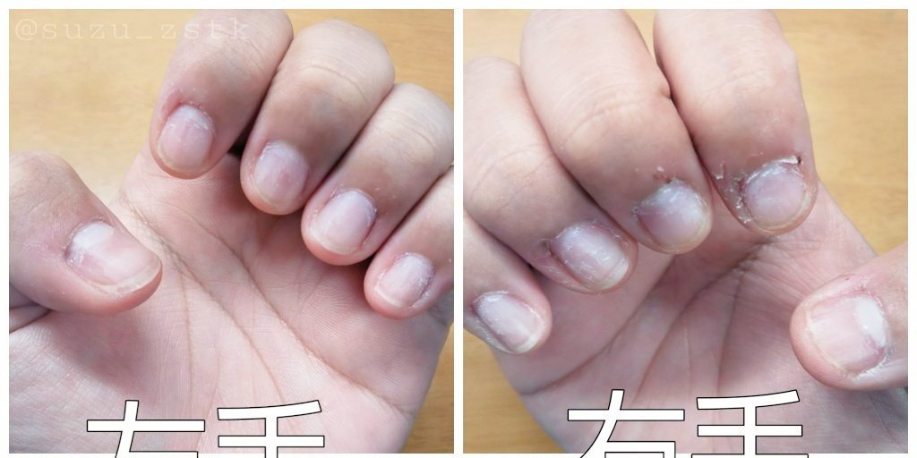 H 皮膚摘み取り症 Etiketa Sto Twitter
