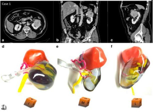 3dheals's tweet image. Assessing the effectiveness of 3d printed medical models for renal surgeries @blender_org #3dprinting #medicalmodels #technology #RenalSurgery #CatalinaLupulescu #ZhonghuaSun #SLA #TangoPlus #3DSlicer #Mimics #JointheTribe buff.ly/2ZRUB1P ift.tt/2H15dDU